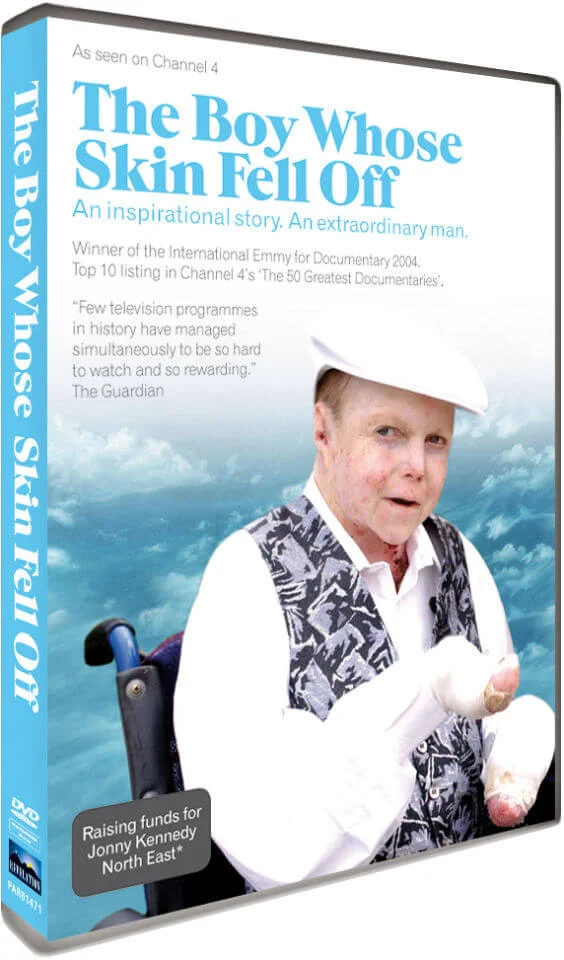 Boy Whose Skin Fell Off Image 1